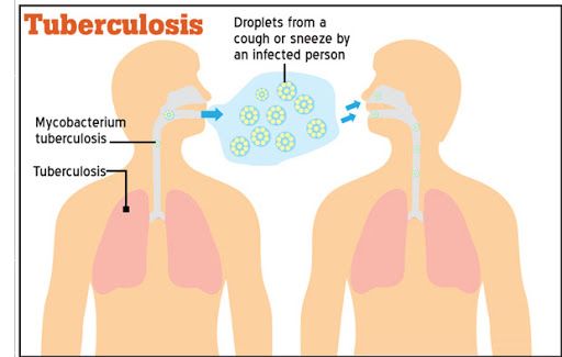 Tuberculosis, archaeologists, cells, lungs, mycobacterial tuberculosis, cell-degrading enzymes